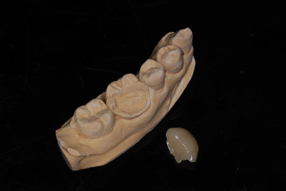 Зубная композитная облицовка Onlay High Aesthetics Composite Veneer